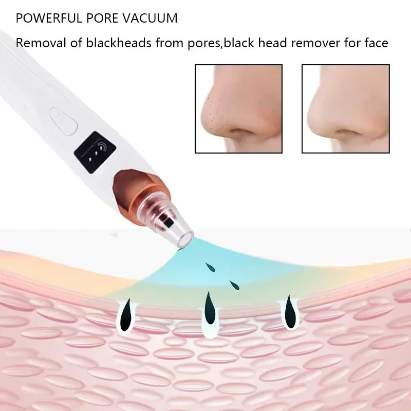 USB Electric Blackhead Removal Vacuum with Suction - Facial Pore Cleaner for Acne and Pimple Extraction