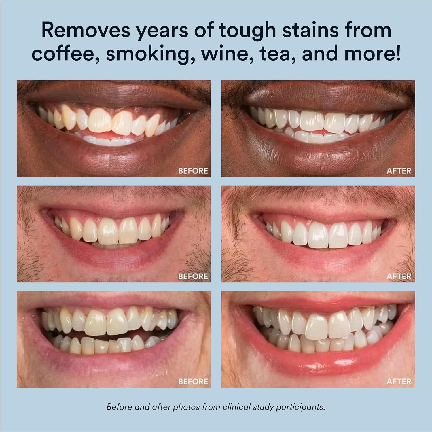 Advanced Teeth Whitening System with LED Accelerator, 35% Carbamide Peroxide Gel, Over 20 Applications, Achieves Up to 10 Shades Whiter in Just 7 Days