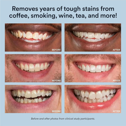 Advanced Teeth Whitening System with LED Accelerator, 35% Carbamide Peroxide Gel, Over 20 Applications, Achieves Up to 10 Shades Whiter in Just 7 Days