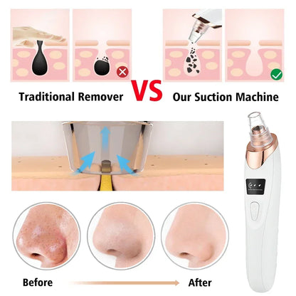 USB Electric Blackhead Removal Vacuum with Suction - Facial Pore Cleaner for Acne and Pimple Extraction